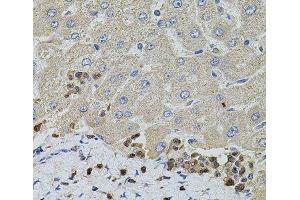 Immunohistochemistry of paraffin-embedded Human liver damage using S100A12 Polyclonal Antibody at dilution of 1:100 (40x lens). (S100A12 抗体)