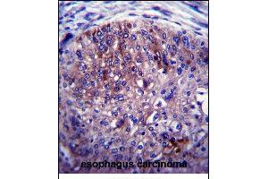 ADAL Antibody (C-term) (ABIN657544 and ABIN2846559) immunohistochemistry analysis in formalin fixed and paraffin embedded human esophagus carcinoma followed by peroxidase conjugation of the secondary antibody and DAB staining. (ADAL 抗体  (C-Term))
