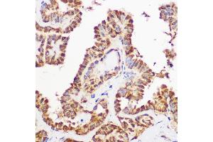 Immunohistochemistry of paraffin-embedded human thyroid using Pan-AKT antibody (ABIN7265519) at dilution of 1:100 (40x lens). (AKT 1/2/3 抗体)