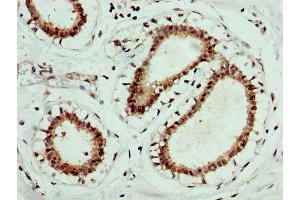 IHC image of ABIN7152021 diluted at 1:400 and staining in paraffin-embedded human breast cancer performed on a Leica BondTM system. (EPOR 抗体  (AA 320-506))