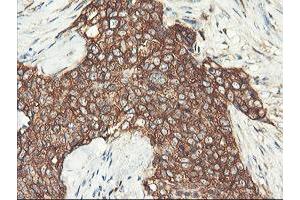 Immunohistochemical staining of paraffin-embedded Adenocarcinoma of Human breast tissue using anti-PFKP mouse monoclonal antibody. (PFKP 抗体)