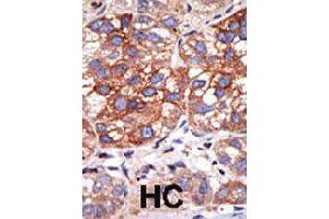 Formalin-fixed and paraffin-embedded human hepatocellular carcinoma tissue reacted with YY1 polyclonal antibody  , which was peroxidase-conjugated to the secondary antibody, followed by DAB staining .