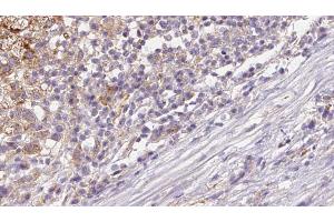 ABIN6272656 at 1/100 staining Human liver cancer tissue by IHC-P. (DNER 抗体  (Internal Region))