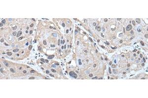 Immunohistochemistry of paraffin-embedded Human esophagus cancer tissue using HELLS Polyclonal Antibody at dilution of 1:30(x200) (HELLS 抗体)