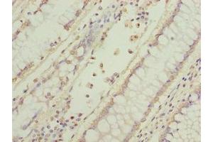 Immunohistochemistry of paraffin-embedded human colon cancer using ABIN7165317 at dilution of 1:100 (EFR3B 抗体  (AA 1-298))