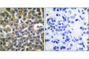 Immunohistochemistry analysis of paraffin-embedded human breast carcinoma tissue, using eEF2 (Ab-56) Antibody. (EEF2 抗体  (AA 31-80))
