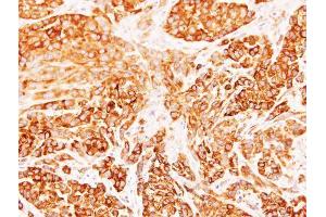 IHC-P Image Immunohistochemical analysis of paraffin-embedded A549 xenograft, using Diablo, antibody at 1:500 dilution.