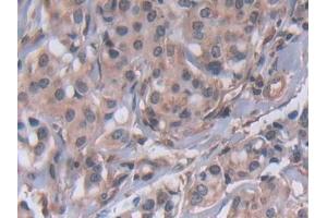 Detection of MMP23B in Human Breast cancer Tissue using Polyclonal Antibody to Matrix Metalloproteinase 23B (MMP23B)