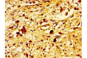 Immunohistochemistry of paraffin-embedded human melanoma using ABIN7174438 at dilution of 1:100 (UBE2D2 抗体  (AA 1-147))