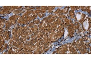 Immunohistochemistry of paraffin-embedded Human thyroid cancer using HSD17B4 Polyclonal Antibody at dilution of 1:30 (HSD17B4 抗体)