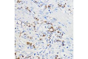 Immunohistochemistry of paraffin-embedded Human oophoroma using BOL Rabbit pAb (ABIN7265891) at dilution of 1:50 (40x lens). (BOLA3 抗体  (AA 1-68))