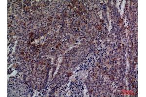 Immunohistochemistry (IHC) analysis of paraffin-embedded Human Lung Cancer, antibody was diluted at 1:100. (CDC34 抗体  (Internal Region))