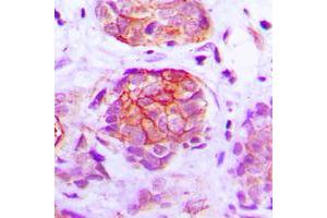 Immunohistochemical analysis of GPR160 staining in human breast cancer formalin fixed paraffin embedded tissue section. (GPR160 抗体  (C-Term))