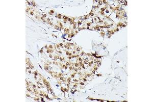 Immunohistochemistry of paraffin-embedded human breast cancer using KIF22 antibody  at dilution of 1:100 (40x lens). (KIF22 抗体  (AA 456-665))