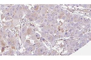 ABIN6272705 at 1/100 staining Human liver cancer tissue by IHC-P. (OR52J3 抗体  (N-Term))