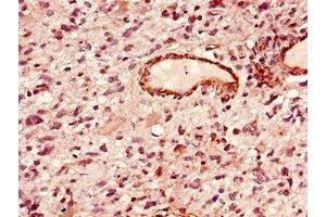 Immunohistochemistry of paraffin-embedded human glioma using ABIN7155905 at dilution of 1:100 (LIPE 抗体  (AA 1-251))