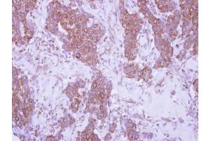 IHC-P Image Immunohistochemical analysis of paraffin-embedded human breast cancer, using CD79b, antibody at 1:250 dilution. (CD79b 抗体  (Center))