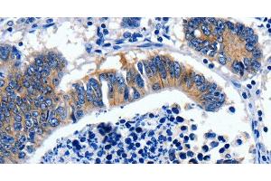 Immunohistochemistry of paraffin-embedded Human colon cancer tissue using GAD2 Polyclonal Antibody at dilution 1:30 (GAD65 抗体)