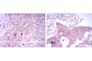 Immunohistochemical analysis of paraffin-embedded lung cancer tissues (left) and ovarian cancer tissues (right) using FOXD3 mouse mAb with DAB staining. (FOXD3 抗体)