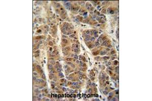 C4BPA antibody immunohistochemistry analysis in formalin fixed and paraffin embedded human hepatocarcinoma followed by peroxidase conjugation of the secondary antibody and DAB staining. (C4BPA 抗体  (C-Term))