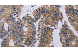 Immunohistochemistry of paraffin-embedded Human colon cancer using PRKD3 Polyclonal Antibody at dilution of 1:50 (PRKD3 抗体)