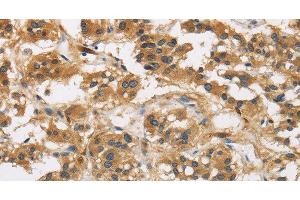 Immunohistochemistry of paraffin-embedded Human thyroid cancer using GAS7 Polyclonal Antibody at dilution of 1:50 (GAS7 抗体)