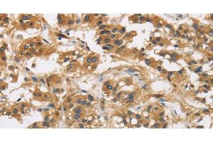 Immunohistochemistry of paraffin-embedded Human thyroid cancer using GAS7 Polyclonal Antibody at dilution of 1:50