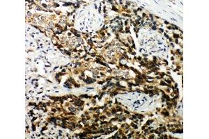 IHC-P: TSC1 antibody testing of human breast cancer tissue (TSC1 抗体  (C-Term))