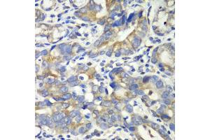 Immunohistochemistry of paraffin-embedded human gastric cancer using ABAT antibody (ABIN1876487) at dilution of 1:100 (40x lens). (ABAT 抗体)