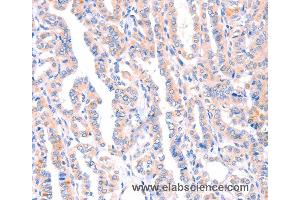 Immunohistochemistry of Human thyroid cancer using AMPD1 Polyclonal Antibody at dilution of 1:70 (AMPD1 抗体)