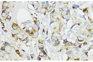 Immunohistochemistry of paraffin-embedded Human mammary cancer using Complement Factor B Polyclonal Antibody at dilution of 1:200 (40x lens). (Complement Factor B 抗体)