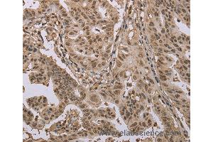 Immunohistochemistry of Human gastric cancer using CAB39 Polyclonal Antibody at dilution of 1:50 (CAB39 抗体)