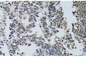 Immunohistochemistry of paraffin-embedded Human lung cancer using LKB1 Polyclonal Antibody at dilution of 1:100 (40x lens). (LKB1 抗体)