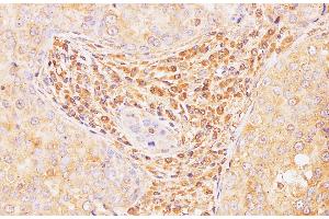 Immunohistochemistry of paraffin-embedded Human breast cancer using Il2 Polyclonal Antibody at dilution of 1:100 (IL-2 抗体)