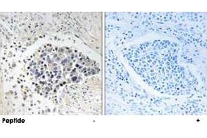 Immunohistochemistry analysis of paraffin-embedded human lung carcinoma tissue using CPNE8 polyclonal antibody . (CPNE8 抗体)