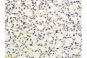 Formalin-fixed and paraffin embedded human gastric adenocarcinoma labeled with Anti-CD162 Polyclonal Antibody, Unconjugated (ABIN679298) followed by conjugation to the secondary antibody (SELPLG 抗体  (AA 251-350))
