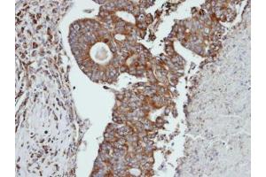IHC-P Image Immunohistochemical analysis of paraffin-embedded human endo mitral ovarian cancer, using CTSS, antibody at 1:100 dilution.