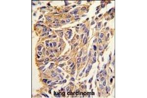 Formalin-fixed and paraffin-embedded human lung carcinoma tissue reacted with T1 antibody (C-term) (ABIN389117 and ABIN2839303) , which was peroxidase-conjugated to the secondary antibody, followed by DAB staining. (PPT1 抗体  (C-Term))