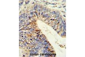 Formalin-fixed and paraffin-embedded human colon carcinoma reacted with ADAMDEC1 Antibody (N-term), which was peroxidase-conjugated to the secondary antibody, followed by DAB staining. (ADAMDEC1 抗体  (N-Term))