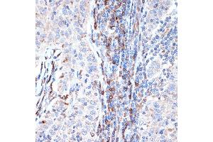 Immunohistochemistry of paraffin-embedded human esophageal cancer using DCP1A Rabbit mAb (ABIN7266678) at dilution of 1:100 (40x lens). (DCP1A 抗体)