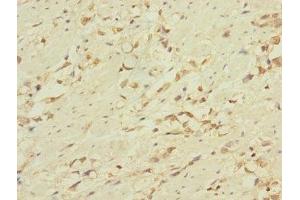 Immunohistochemistry of paraffin-embedded human gastric cancer using ABIN7158286 at dilution of 1:100 (CD53 抗体  (AA 100-180))