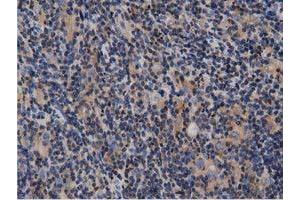 Immunohistochemical staining of paraffin-embedded Human lymphoma tissue using anti-ARHGAP25 mouse monoclonal antibody. (ARHGAP25 抗体)