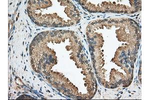 Immunohistochemical staining of paraffin-embedded Adenocarcinoma of Human ovary tissue using anti-BCL10 mouse monoclonal antibody. (BCL10 抗体)