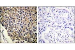 Immunohistochemistry analysis of paraffin-embedded human breast carcinoma, using IL-8R beta/CDw128 beta (Phospho-Ser347) Antibody. (CXCR2 抗体  (pSer347))