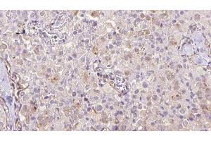 ABIN6273333 at 1/100 staining Human thyroid cancer tissue by IHC-P. (TRAPPC9 抗体  (Internal Region))