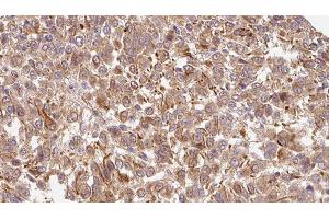 ABIN6278211 at 1/100 staining Human Melanoma tissue by IHC-P. (Biglycan 抗体  (C-Term))