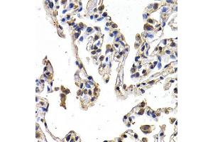 Immunohistochemistry of paraffin-embedded human lung cancer using VEGFD antibody (ABIN5970538) at dilution of 1/200 (40x lens). (VEGFD 抗体)