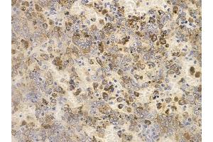 ABIN6256218 and ABIN6267659 at 1/100 staining human melanoma by IHC-P. (SMAD2 抗体  (pSer250))