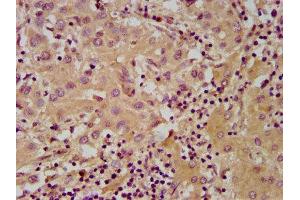 IHC image of ABIN7143530 diluted at 1:600 and staining in paraffin-embedded human liver cancer performed on a Leica BondTM system.
