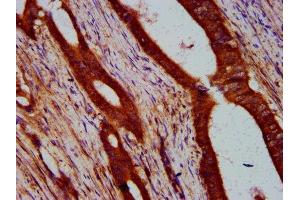 IHC image of ABIN7169209 diluted at 1:400 and staining in paraffin-embedded human colon cancer performed on a Leica BondTM system. (ULK2 抗体  (AA 211-276))